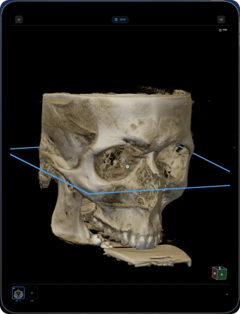 3D rendering of a CBCT volume with a clipping plane in Ossidex on iPad
