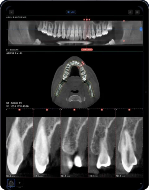 Dental CBCT in Ossidex on iPad: panoramic arch, axial slice with the traced arch and cross-sections of the teeth