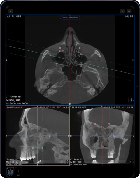 CBCT of the head shown in MPR with reference lines in Ossidex on iPad