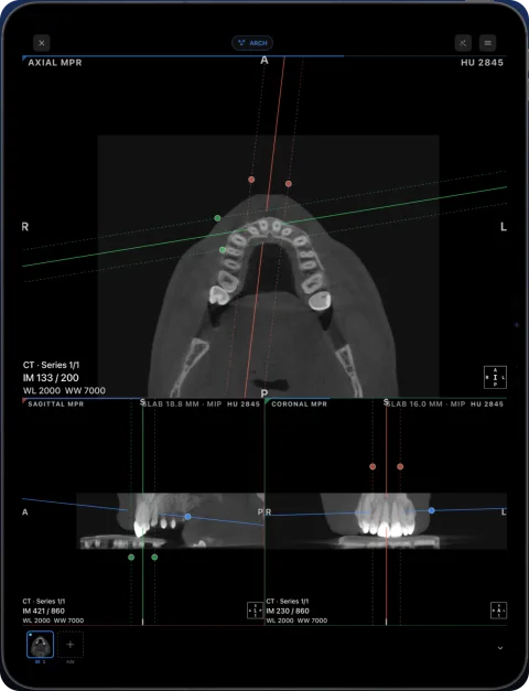 Ossidex on iPad showing axial, sagittal and coronal MPR of a dental CBCT