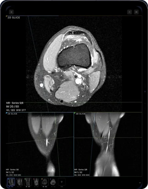 MRI volume viewed in linked panels in Ossidex on iPad