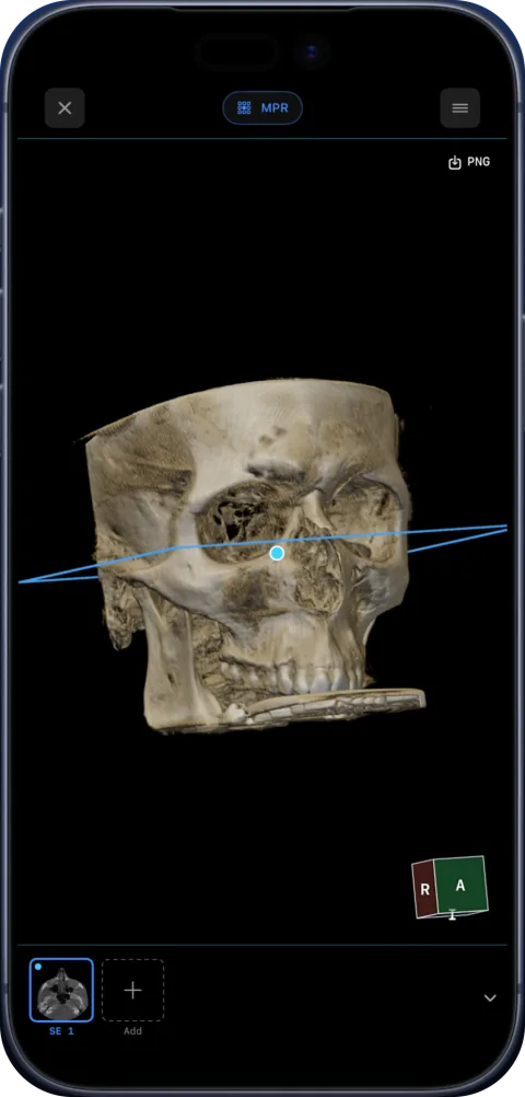3D rendering of a skull from CBCT with a clipping plane in Ossidex on iPhone