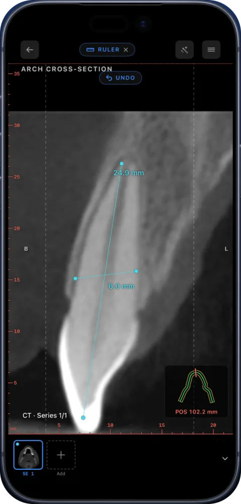 Length measurement along a tooth root on an arch cross-section in Ossidex on iPhone