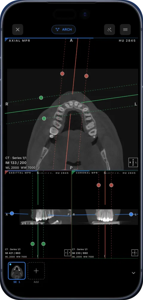 CBCT in Ossidex on iPhone with axial, sagittal and coronal MPR views