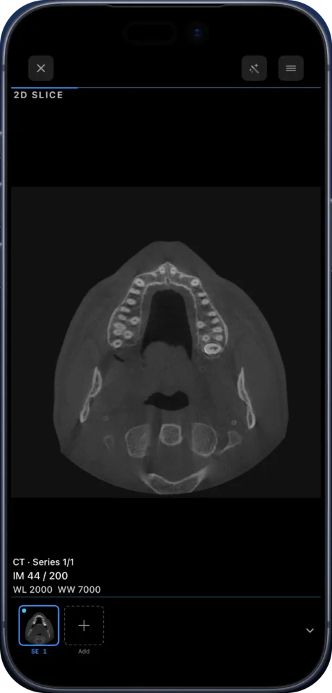 An axial slice of a CT scan in Ossidex on iPhone